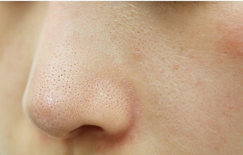 Mụn cám khiến da mặt sần sùi, xù xì