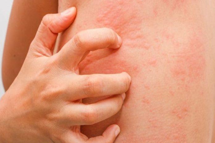 làm gì khi bị dị ứng da